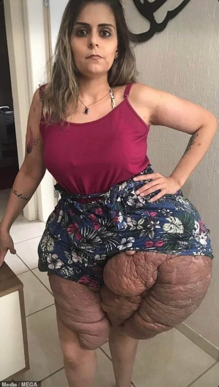 Woman’s life is being ‘consumed’ by her giant leg and hip tumours caused by a genetic condition which has left her jobless and housebound –